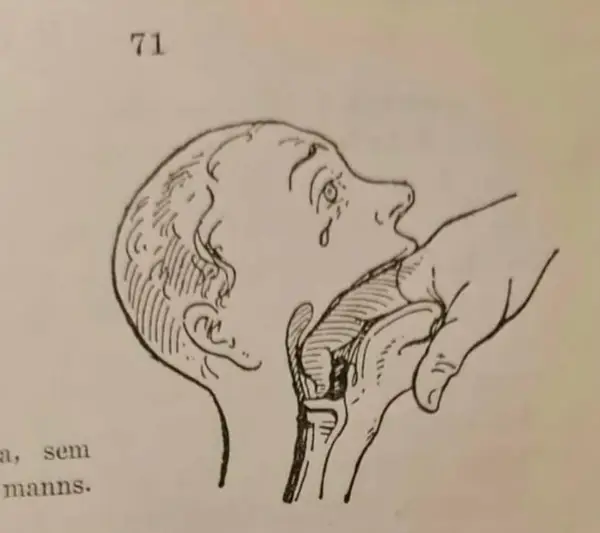 Obrázok zobrazujúci anatómii úst a hrtana počas lekárskeho vyšetrenia prstom.