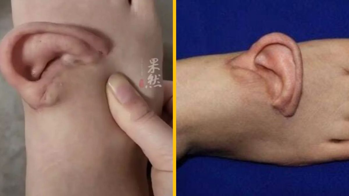 Umelé uši vytvorené z kože ruky, porovnanie dvoch modelov.