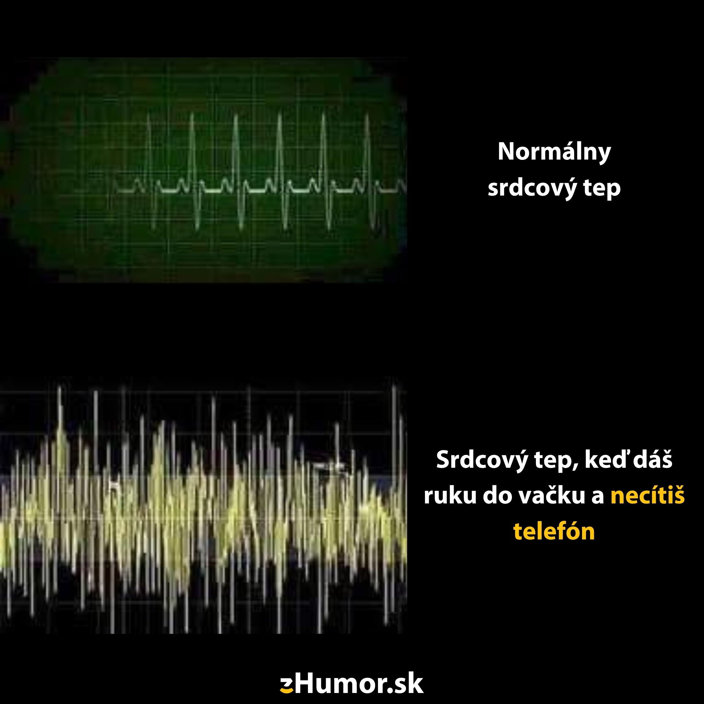 EKG graf s normálnym a zrýchleným srdcovým pulzom ilustrujúci stres pri hľadaní telefónu vo vrecku.
