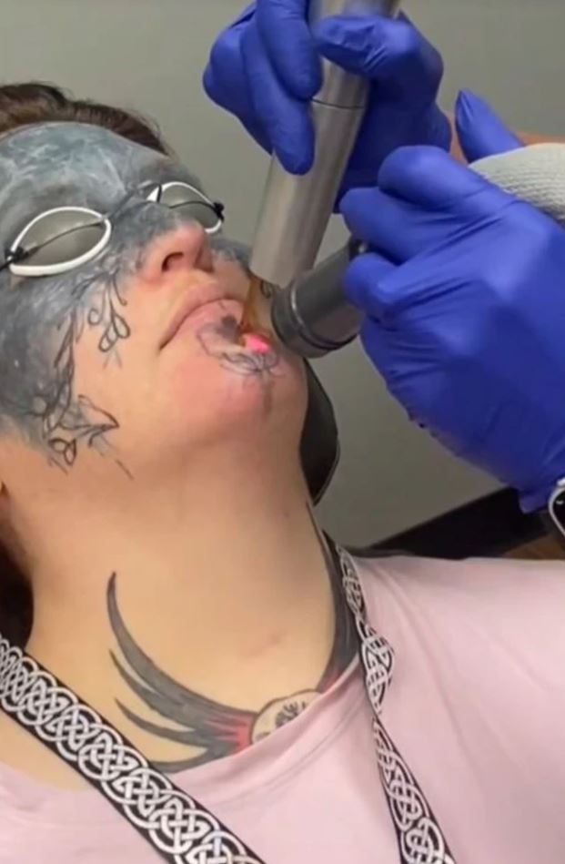 Osoba počas procesu odstraňovania tetovania pomocou laseru, chránená okuliarmi, nosiac rukavice.