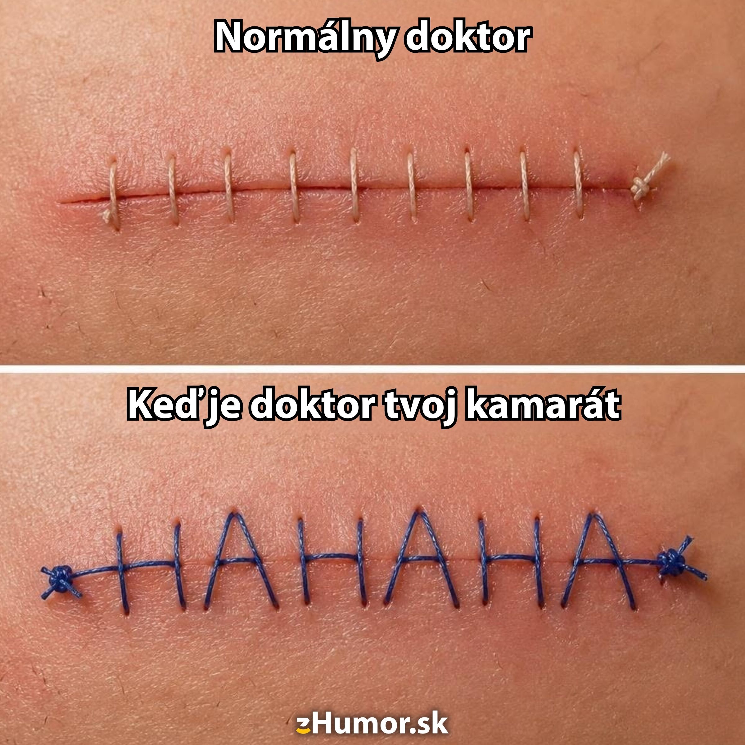 Horný steh je klasický, spodný vtipný so slovom HAHAHA. Obe ukazujú rôzne prístupy k zošitiu rán.